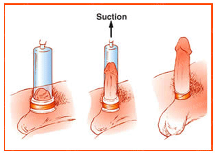Cung cấp Máy tập penis pump làm to và kéo dài dương vật - SHP507 giá sỉ